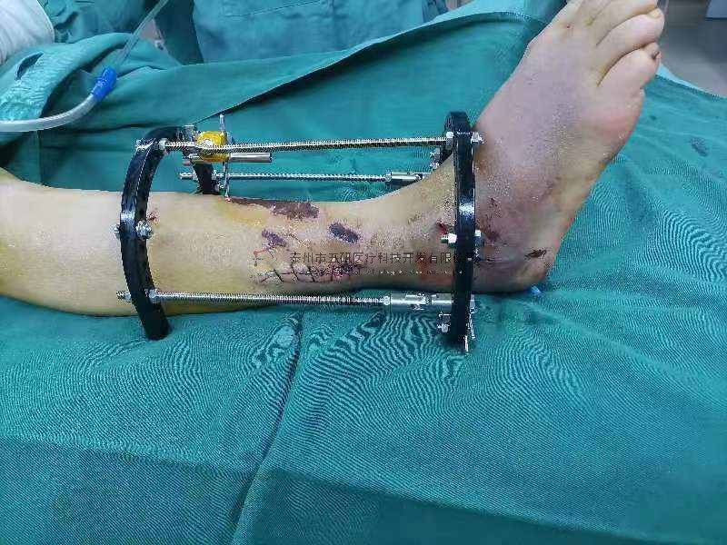 病例分享——踝關節粉碎性骨折(PILONG骨折)(糖尿病?局部皮膚條件差) 病例分享——踝關節粉碎性骨折(PILONG骨折)(糖尿病?局部皮膚條件差)